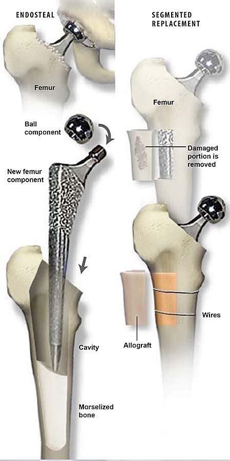 Revision Hip With Allograft Central Coast Orthopedic Medical Group