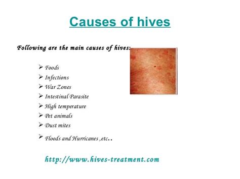 Can A Fever Cause Hives Can A Fever Cause Hives Msxeybegmm