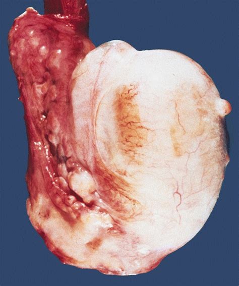 Mesothelioma is difficult to diagnose by examining the macrostructure of the tumor. Pathology Outlines - Mesothelioma (malignant)