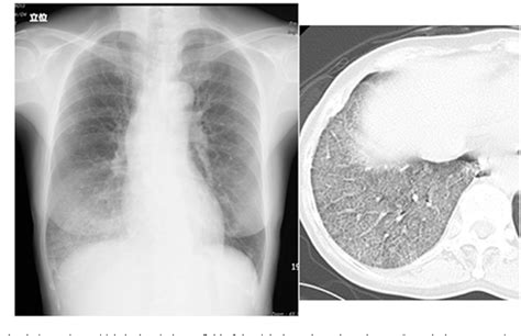 Figure From A Case Of Lipoid Pneumonia Caused By Inhalation Of