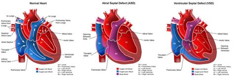 Heart Disease Congenital Heart Defect