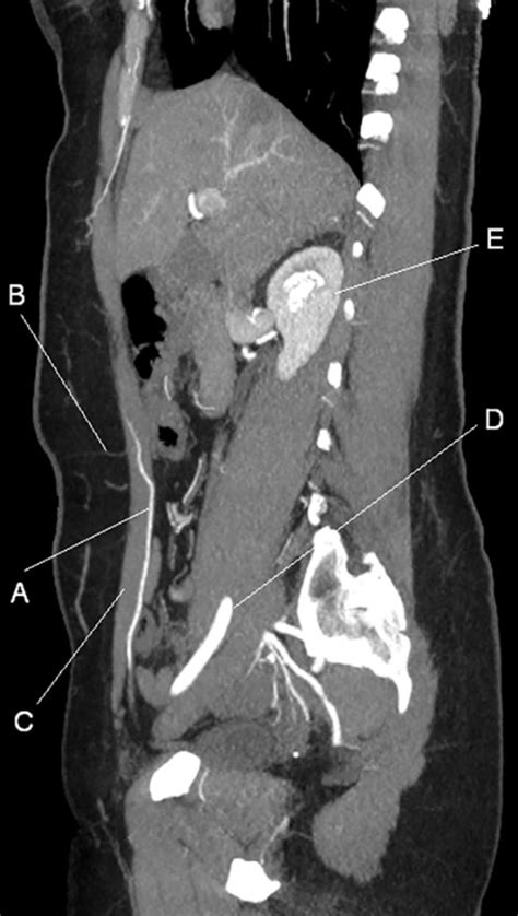 Sagittal Computed Tomography Angiogram Of The Abdomen With Contrast