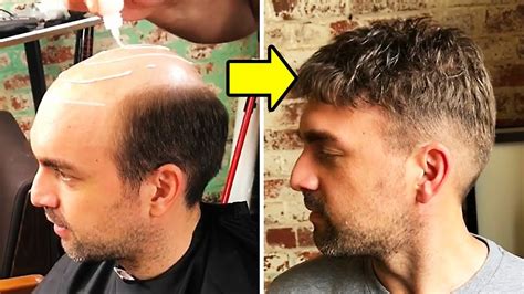Non Surgical Hair Replacement System For Men Hair Transformation