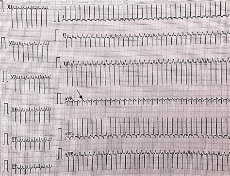 Ecg interpretation of arrhythmias tusom pharmwiki. Crisis EKG (10 mm/s): PSVT 120 bpm, QRS axis at-45 degrees ...