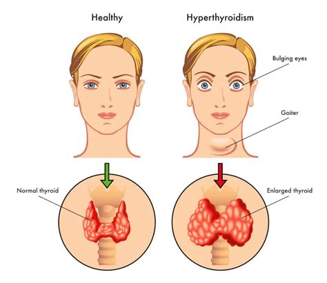Diagnosis Treatment For Hyperthyroidism Problem Livofy