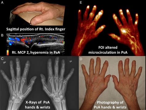 Detection Of Clinically Manifest And Silent Synovitis In The Hands And