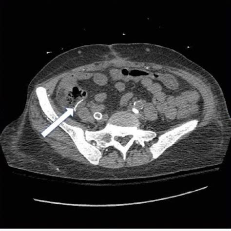 Ct Of The Abdomen And Pelvis Without Contrast Findings Showing