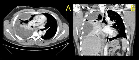 Cureus Vaping Induced Sepsis And Rapidly Evolving Pleural Effusion In