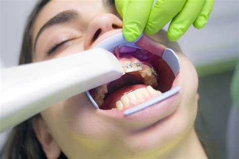 Qué Debes Saber Antes De Ponerte Brackets ⚕️ Clínica Dental Urbina