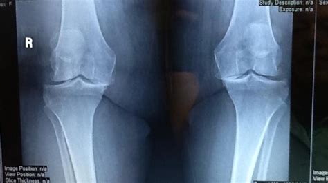 Dennis M Lox Md Explains How To Read A Bone On Bone Knee X Ray