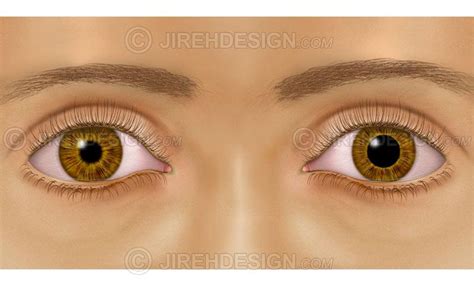 Anisocoria Eye Condition Medical Eye Illustration Co0053