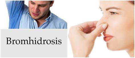 Bromhidrosis Causas Síntomas Diagnóstico Tratamiento