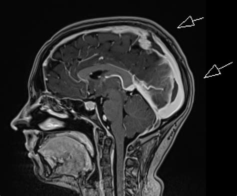 Intracranial Hypotension With Dural Sinus Thrombosis