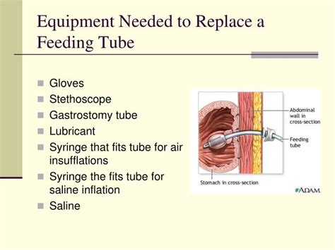 Ppt Gastrostomy Tube Reinsertion Powerpoint Presentation Id1794462