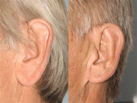 67 Year Old Earlobe Reduction Before After Photo Plastic Surgery
