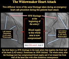 Widowmaker Heart Attack Explained by Cardiologist • MyHeart