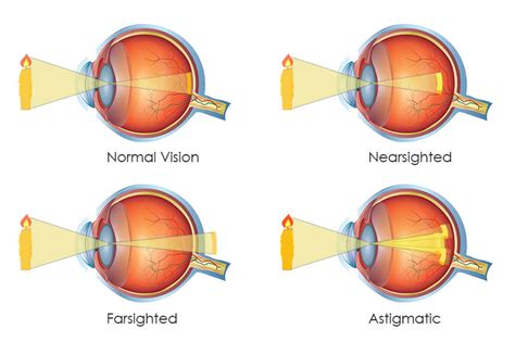 Is it Genetic to be Near-sighted, Far-Sighted or Astigmatic?