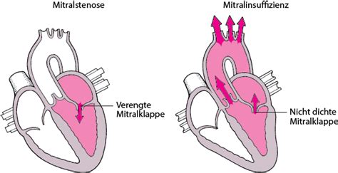 Übersicht über Erkrankungen Der Herzklappen Herz Und Gefäßkrankheiten Msd Manual Ausgabe