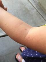 Scratch rash definition / meaning should not be considered complete, up to date, and is not intended to be used in place of a visit, consultation, or advice of a legal, medical, or any other. 5 Tips For Treating Toddler Eczema