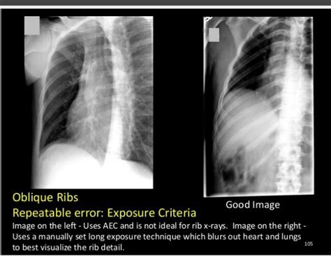Oblique Ribs Medical Anatomy Radiology Technician Radiology Student