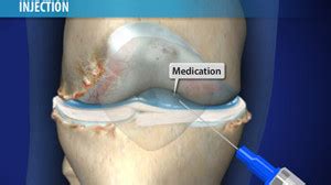 Cartilage covers the knee's bones. Total Joint Replacement - Specialties - The Centers for ...