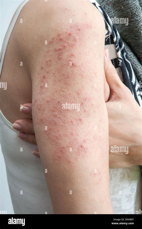 Allergic Rash Dermatitis Skin Texture Of Patient Stock Photo Alamy