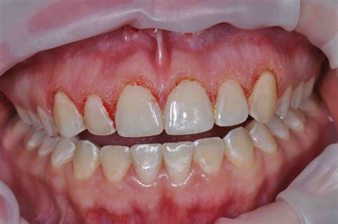 Laser Gingivectomy Web Lee Ann Brady Dmds Dental Blog