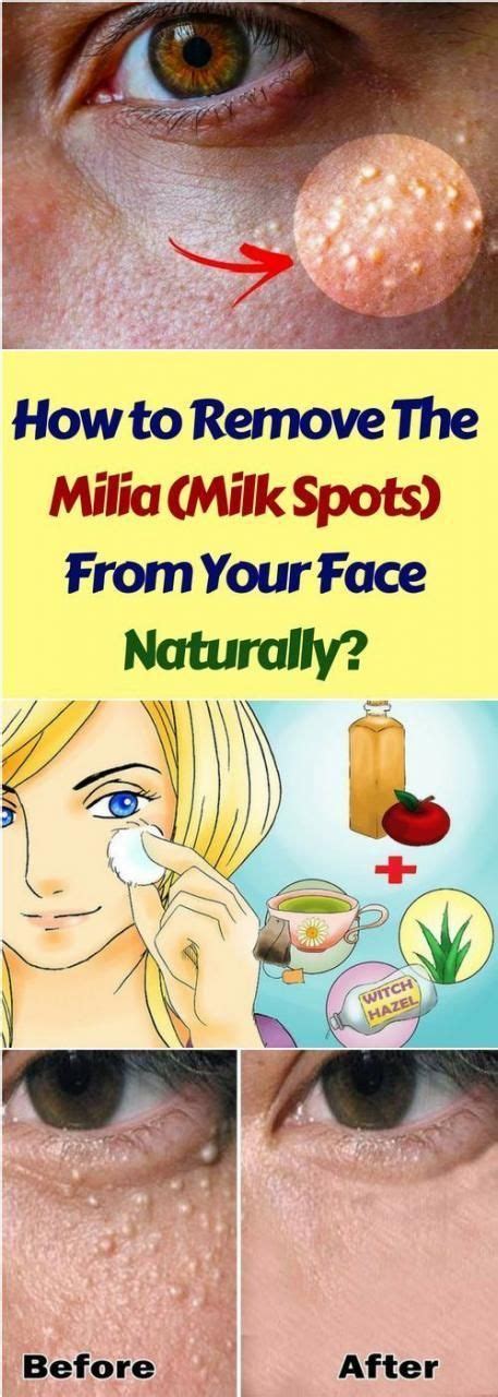 How To Remove The Milia Milk Spots From Your Face Naturally