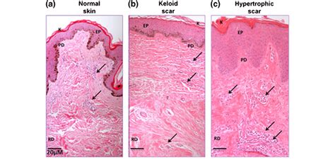 Histology Of Normal Skin Sample Compared Hypertrophic And Keloid Scars