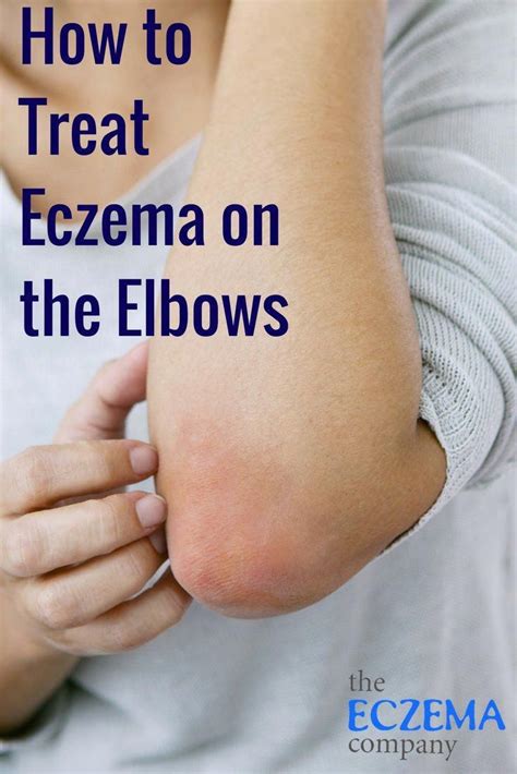 How To Treat Eczema On Elbows The Eczema Company