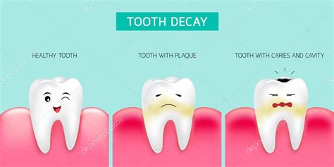 Paso De Formación De Caries Dental Diente Sano Formando Placa Dental