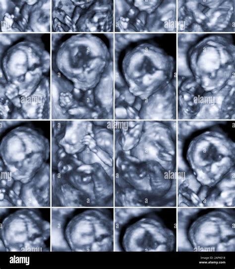 Collage Of 16 Medical Images Of 3d Ultrasound Anomaly Scan On A Female