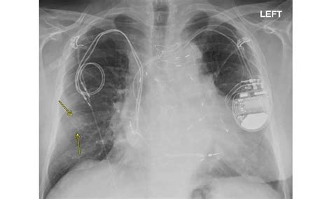 Mri Safely Performed In Patients With Pacemakers And Icds Freeschi