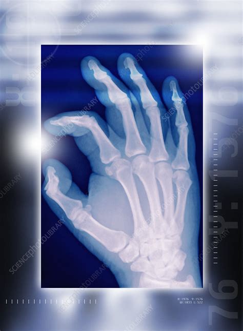 Healthy Hand X Ray Stock Image P1160539 Science Photo Library