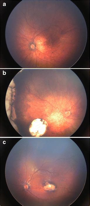 Fundoscopy Showing A Focal Pigment Mottling Of The Retina B Optic