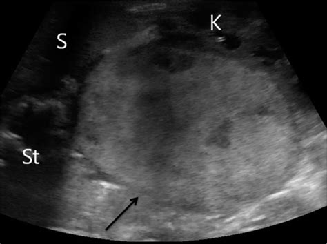 Sonography Of Primary Cervical Neuroblastoma In The Infant American