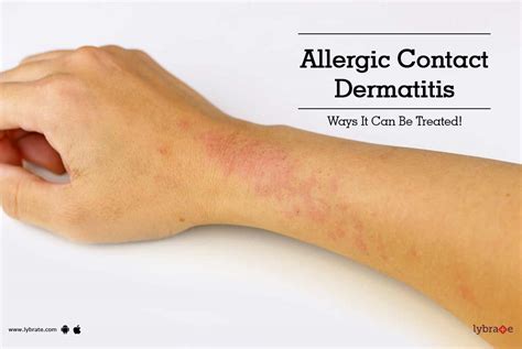 Allergic Contact Dermatitis Treatment