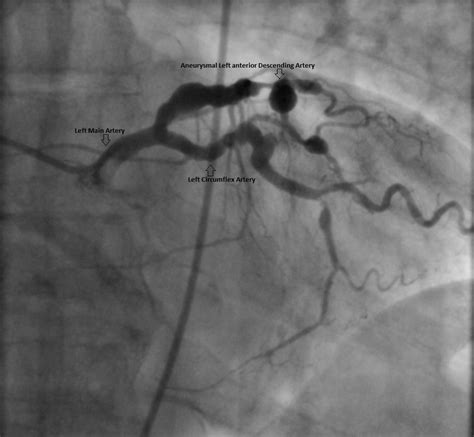 A Patient With A Giant Coronary Artery Aneurysm American College Of