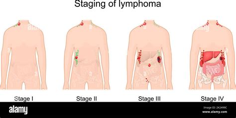 Stage Of A Lymphoma Cancer Of The Lymphatic System Signs And Symptoms