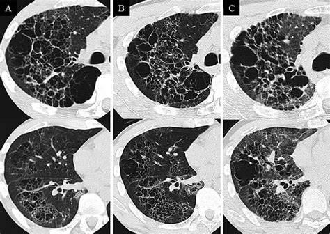 Chest High Resolution Computed Tomography Hrct Images A Initial