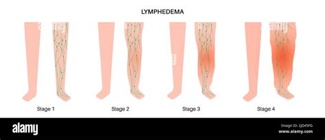 Stages Of Lymphoedema Illustration Stock Photo Alamy