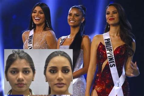 ‘before And After Surgery Photos Of Miss Universe 2018 2nd Runner Up Go Viral Dimsum Daily