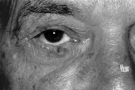Successful Treatment Of Squamous Cell Carcinoma Of The Lower Eyelid