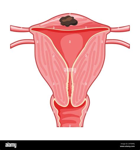 Focal Adenomyosis Human Anatomy Female Reproductive Sick System Organs Location Scheme Uterus