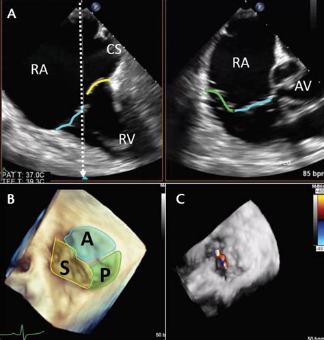 Cardiac Interventions Today Imaging Considerations For Percutaneous