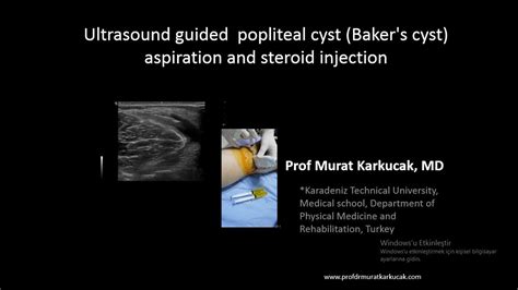 Ultrasound Guided Popliteal Cyst Bakers Cyst Aspiration And Steroid