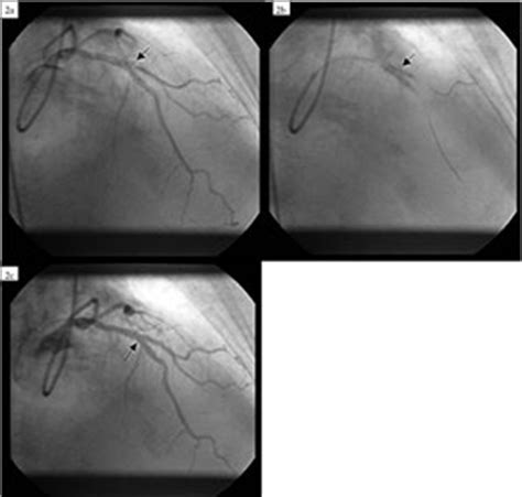 Coronary arteries, trunk, left anterior descending, left circumflex, diagonal. Provisional Reverse ‚ÄúMini-Crush‚Äù Technique for Bifurcation Angioplasty | Journal of Invasive ...