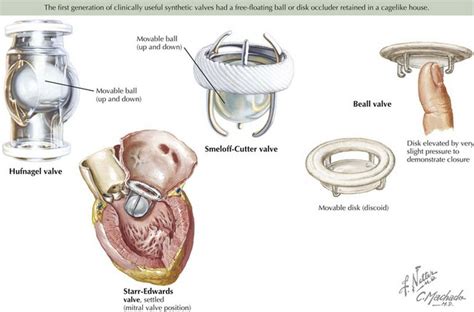 Surgical Treatment Of Valvular Heart Disease Thoracic Key