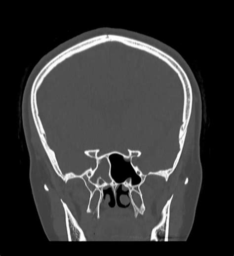 Ct Of Paranasal Sinuses Showing Opacification Of Right Sphenoid Sinus