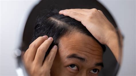 Can Hair Loss From Dehydration Be Reversed Codeewarisha